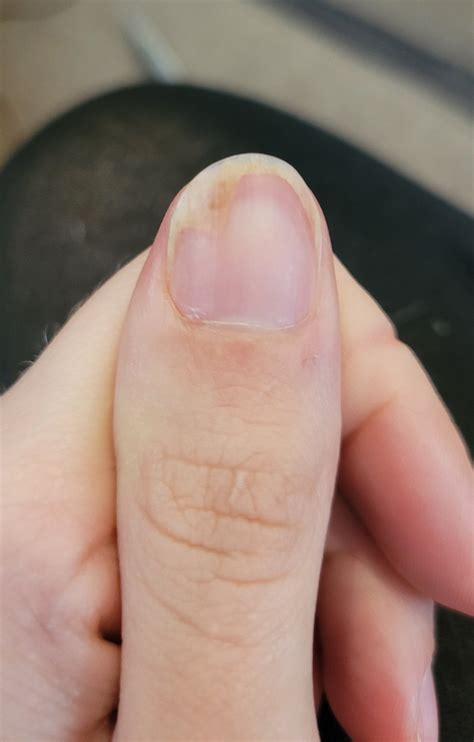 Is this fungus? If so, what's best for finger nails? : r/NailFungus