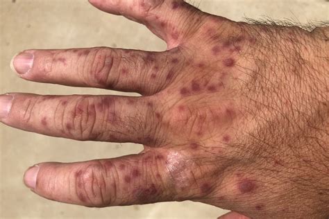 Skin Rash After Ocean at Ava Lazarev blog