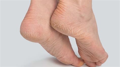 cracked heels nutritionfactin