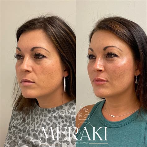 Facial Balancing in Cornelius, NC | Meraki Aesthetics