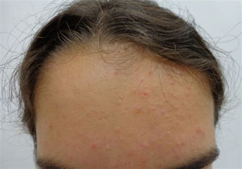 ACD A-Z of Skin - Acne Vulgaris