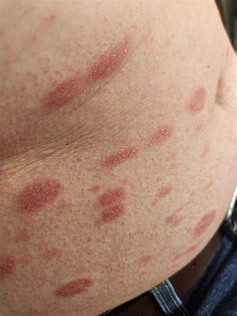Pityriasis Rosea or Tinea Versicolor? : r/DermatologyQuestions