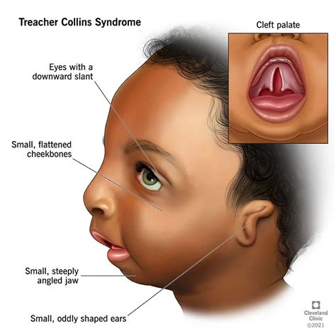 treacher collins syndrome dentmistry