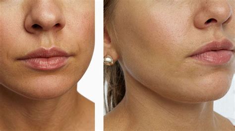 Chin Botox Before and After: Stunning Transformations | Aurawerks