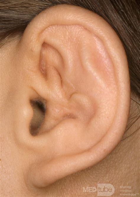 Cauliflower Ear • Image • MEDtube.net