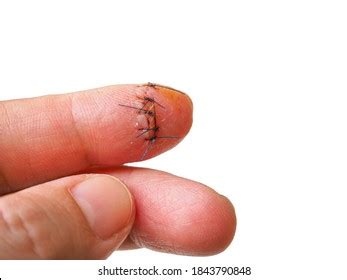 Closeup Hand Wound Stitches Stock Photo 1843790848 | Shutterstock