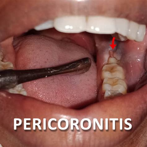 Pericoronitis | Hilton Dental Clinic