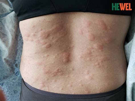 Những điều cần biết về hình ảnh bệnh lupus ban đỏ hiện tại