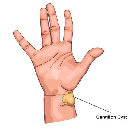 hand wrist surgery  leeds skin surgery clinic