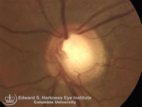 Glaucomatous Optic Nerve | Vagelos College of Physicians and Surgeons