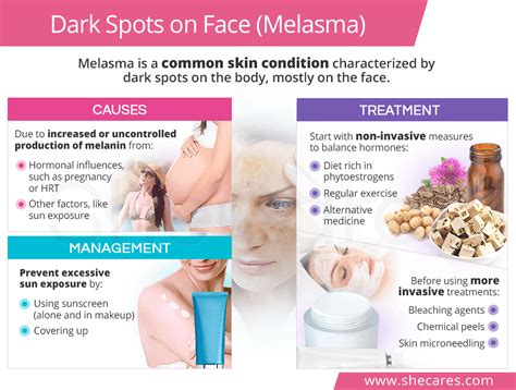 Dark Spots on Face (Melasma) | SheCares