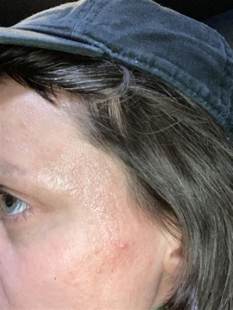 Scaling and flaking… dermatologists keep calling it allergies, but I