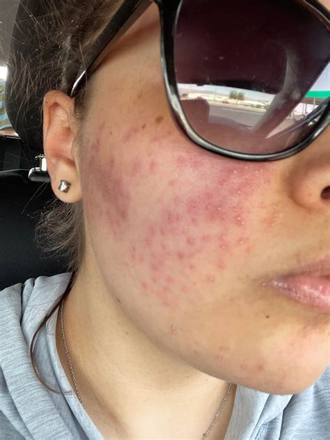 [Skin Concerns] Bad allergic reaction, and I have a huge presentation