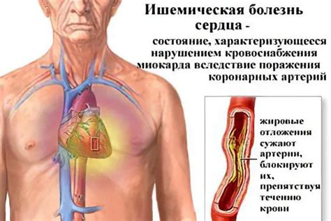 Causes, symptoms and treatment of cardiac ischemia – Healthy Food Near Me