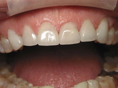 Tetracycline Stain and Worn Teeth Fort Worth, TX | Fort Dental
