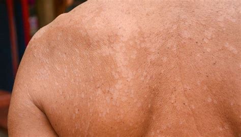 Fungo Na Pele É Contagioso - Pano branco na pele é contagioso? Como tratar a pitiríase versicolor | Ge