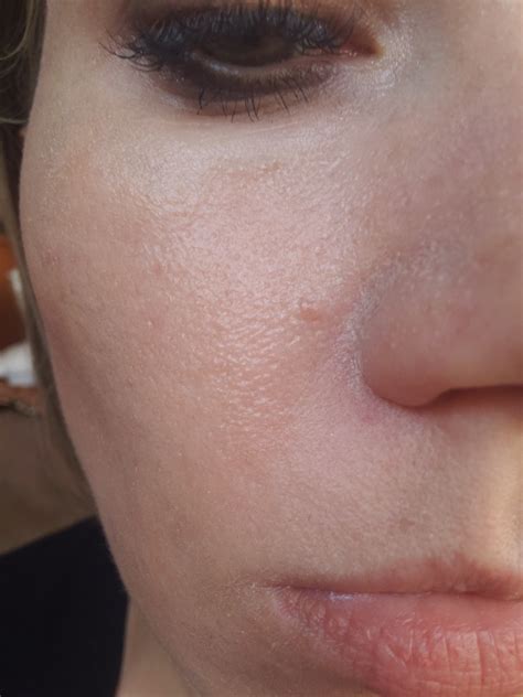 Retin A Damage – Prescription acne medications – Acne.org Forum