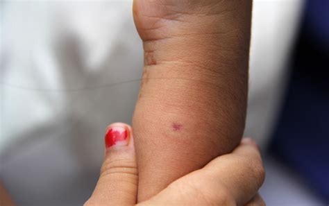 The 7 Best Essential Oils For Bug Bites And Insect Repellent