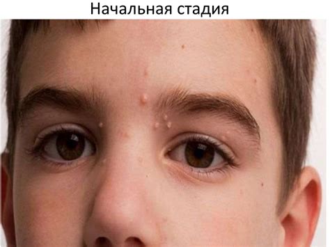 Контагиозный моллюск - презентация онлайн