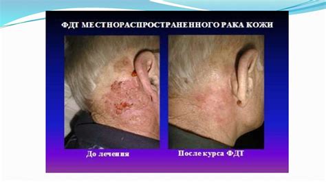Лазерная терапия - презентация онлайн