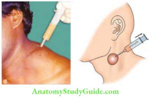 cervical tuberculous lymphadenitis notes anatomy study guide