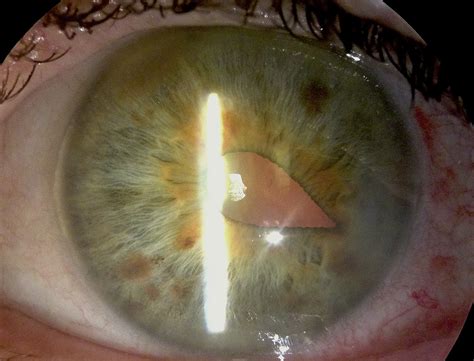 Peaked Pupil One Day After Cataract Surgery: August consulta ...