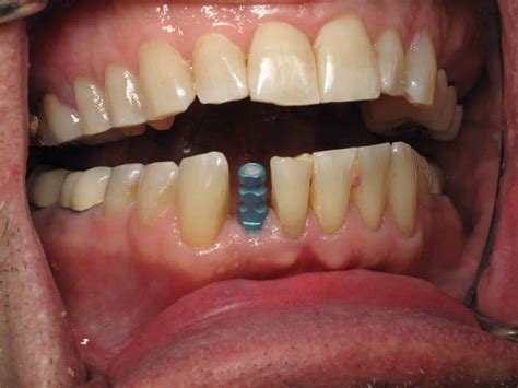 Lower Front Tooth Implants