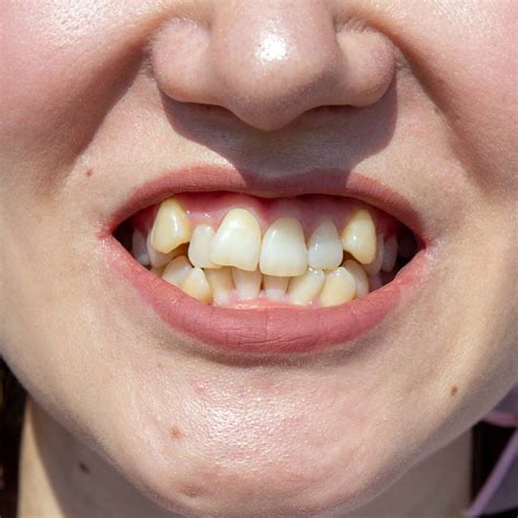 Apiñamiento dental — Centro Dental Bailén: Doctoras Díaz y Cuadros