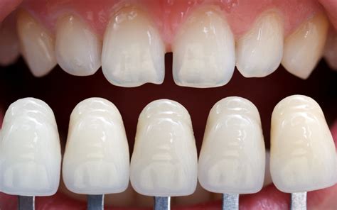 Learn More and Get Answers About Dental Veneers