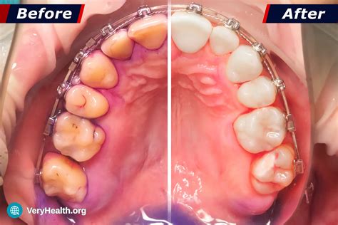 Can You Remove Tartar Without A Dentist? - VeryHealth