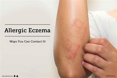 Allergic Eczema - Ways You Can Contact It! - By Dr. Jyoti Chourasia ...