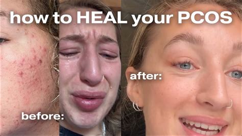 pcos    acne