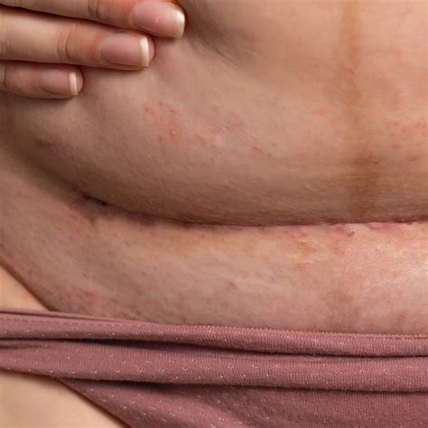 Internal C Section Scar C Section Shelf | How To Get Rid Of C Section