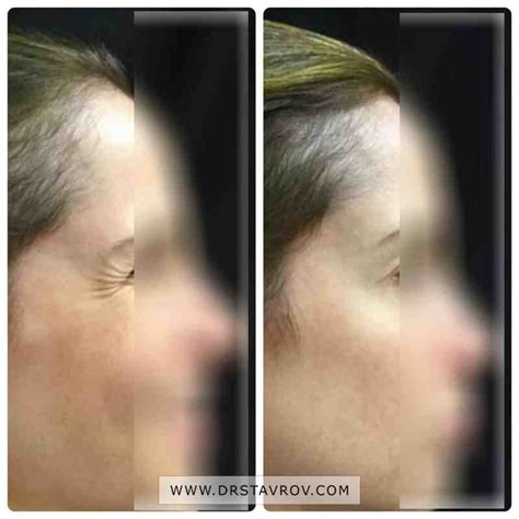 Бръчки около очите. Бръчки тип пачи крак. Цена - Dr. Stavrov Aesthetics