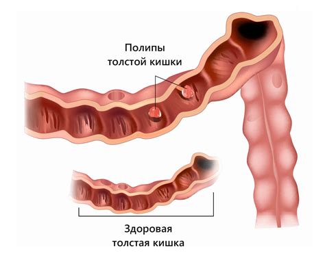 Полипы (полипоз) в толстой кишке: классификация, их удаление в ...