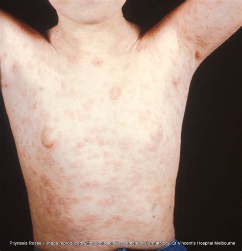 Pityriasis rosea - A - Z of Skin