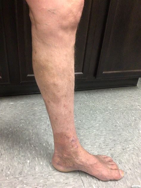 Leg (Venous) Ulcer Treatment in Westminster | Circulatory Issues in Legs