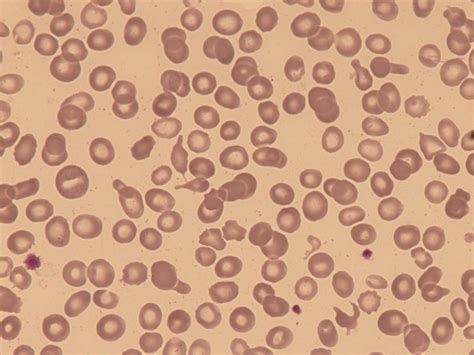 Anisocytosis Rbc