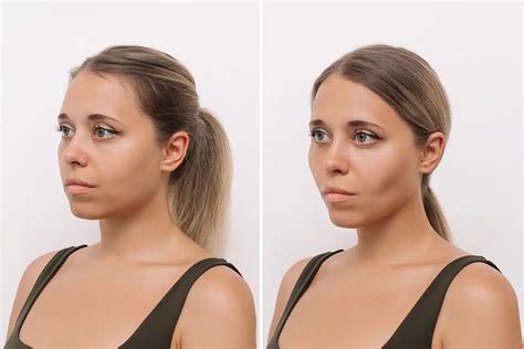 !Buccal Fat Removal Before And After: What To Expect!