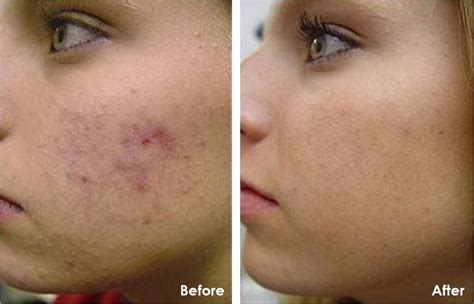 Refresh Your Skin with a Chemical Peel | Carolina Medical Associates