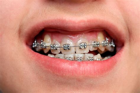 Permanent Brace Behind Teeth at Thomas Gabaldon blog