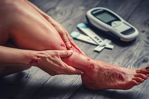 How Can Diabetics Improve Circulation in Feet? | Foot Ankle Specialty ...