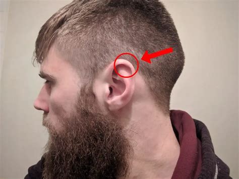 Cauliflower Ear How Does It Happen at William McKoy blog