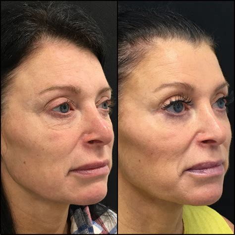 Lower Blepharoplasty Before & After Photos | Flora Levin MD
