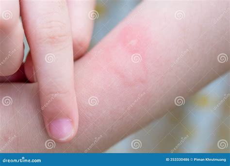 La Niña Tiene Erupción Cutánea Alergia Picor Y Raspado En El Brazo Foto