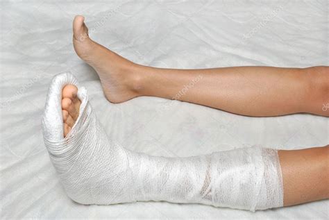 broken leg stock photo  kilukilu
