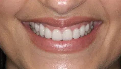 All-On-4 Dental Implants Mesa AZ | My Dental Dentistry & Implants