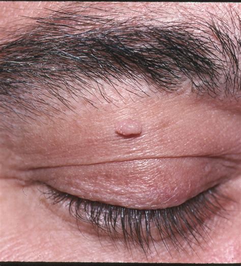 Filiform Wart Eyelid