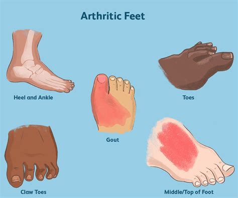 Podiatrists for Arthritis Surgery in Huntington Hills