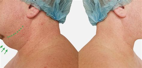 Neck Fat Removal. Neck Fat Removal is a procedure that… | by ...